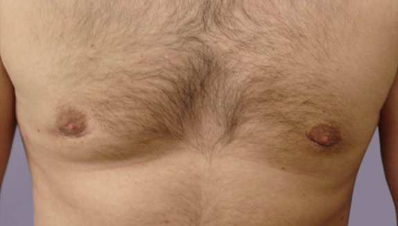 Gynecomastia - after 6 months